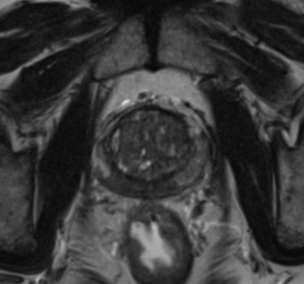 T2 axial Caso clínico PSA = 4 ng/ml RM da Próstata Observa-se alteração do sinal nas imagens ponderadas em T2 da prostata periférica, na base e no terço médio, com localização predominantemete