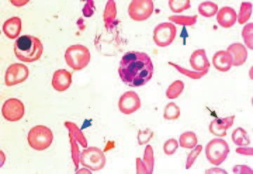 Questão 4 Os fenômenos (1) e (2) são os principais aspectos clínicos da anemia falciforme.