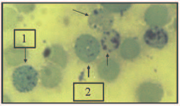 Questão 7 Paciente do sexo masculino, com quatro anos de idade, apresenta anemia microcítica e hipocrômica.