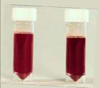 Hemoglobinúria hemoglobinúria