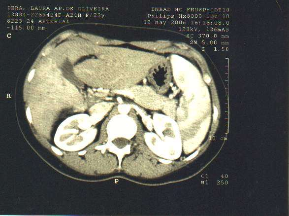 Diagnóstico TC abdominal * HCFMUSP Trombose suprahepática ramo E