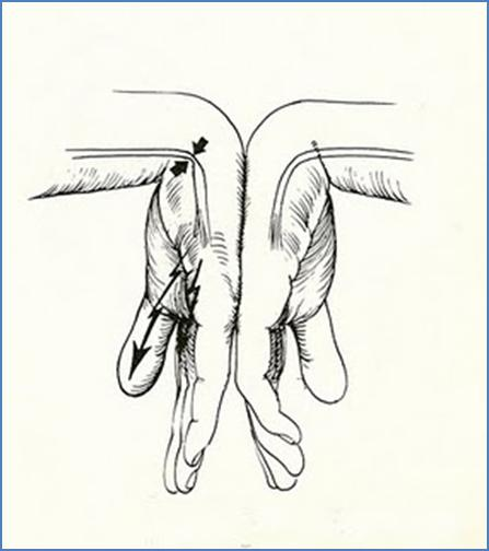 8 repetitivos (LER), lesões osteomusculares relacionadas ao trabalho (DORT). A lesão do nervo mediano traz grande prejuízos para a função da mão (LIANZA, 2005).