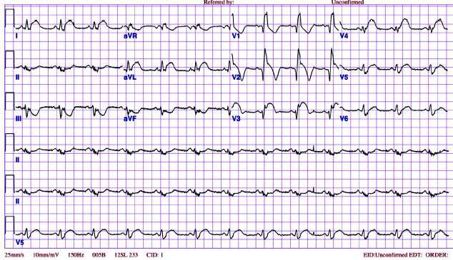 4. O tratamento percutâneo da estenose mitral tem sua indicação bem estabelecida, envolvendo critérios clínicos e anatômicos.