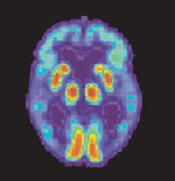 ALTERAÇÕES NEUROPATOLÓGICAS Normal Doença de Alzheimer Adapted from: American Health Assistance