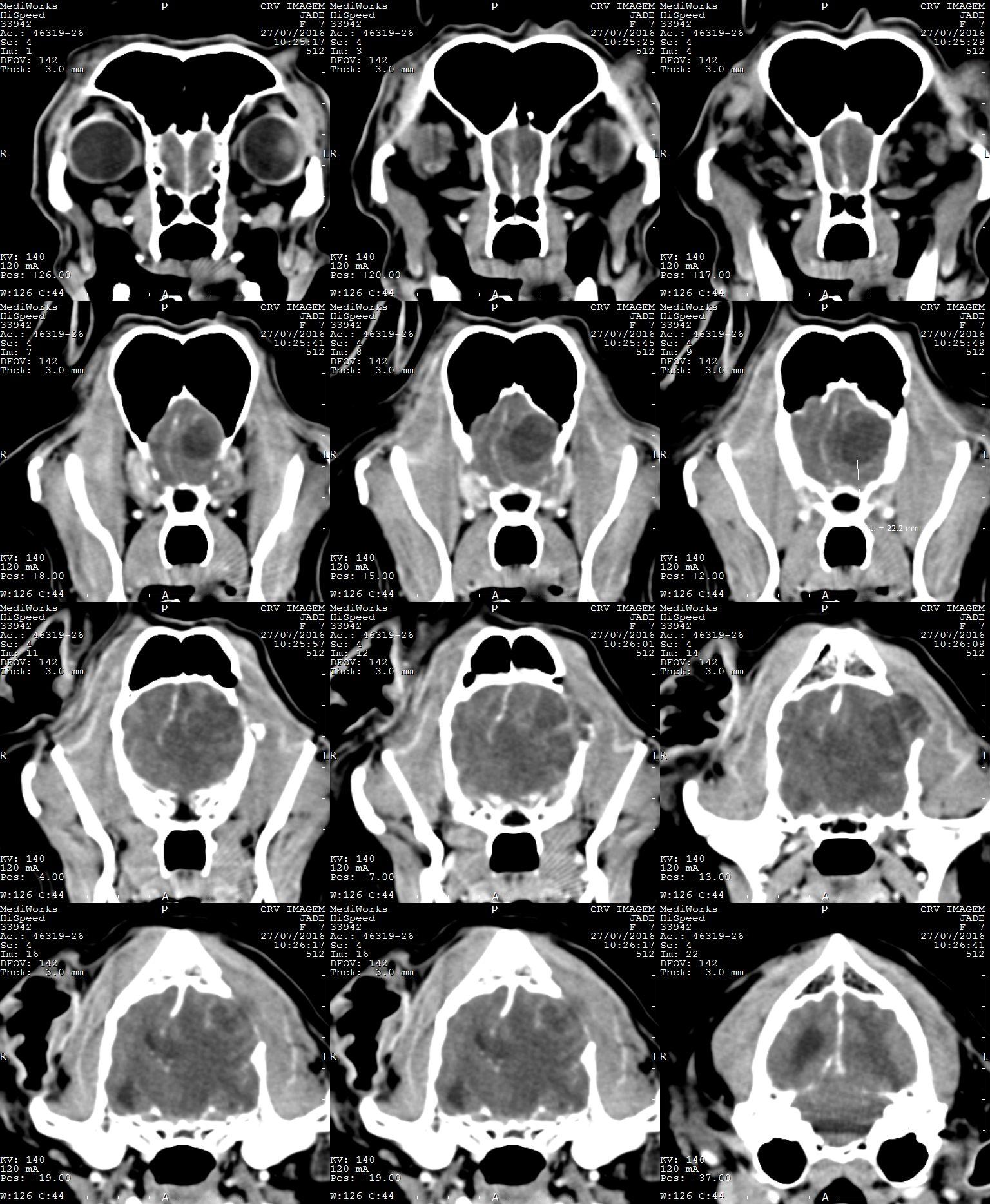 Encefalite Jul/16 Outros sinais corticais mais severos Aumento da lesão 3,4