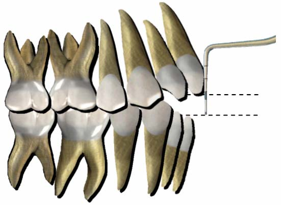 27 Figura 3. Medição do overjet maxilar e mandibular anterior com a sonda CPI.