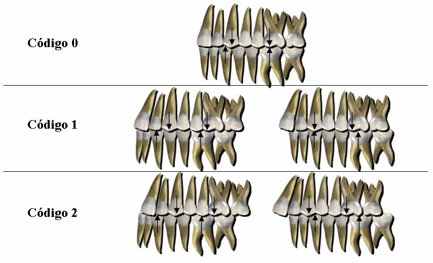 28 Relação Molar Antero-Posterior A avaliação é feita com base na relação entre os primeiros molares permanentes, superior e inferior.