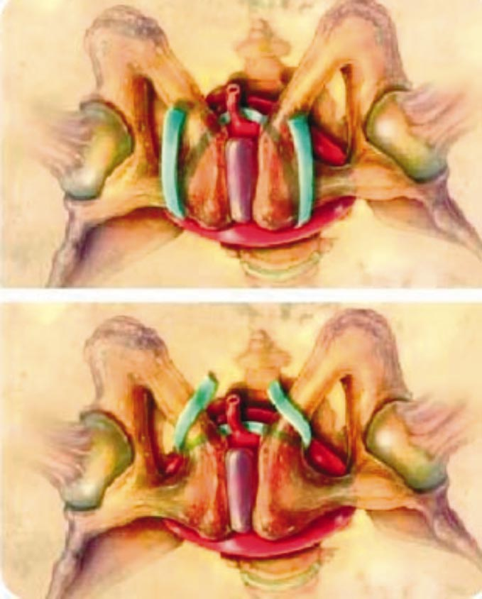 2 Francisco Botelho, Carlos Silva, Francisco Cruz Acta Urológica 2007, 24; 1: Separata Fig 1 Slings sub-uretrais em posição transobturadora (A) e retropúbica(b) Hiperactiva.