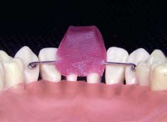 Alternativas para a fixação da contenção fixa ântero-inferior durante a colagem a b c Figura 6 - Passo-a-passo da fixação da contenção com cera utilidade.