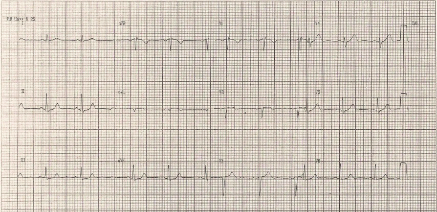 Síndrome coronariana aguda em paciente jovem com sintomas atípicos Exame clínico inicial com pressão arterial de 140/90 mmhg em ambos os membros superiores, freqüência cardíaca de 80 bpm, sem