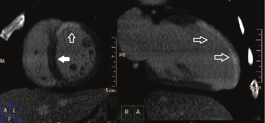 Daher G, Staniak HL, Bittencourt MS, Sharovsky R. Figura 2A - Imagem da coronariografia invasiva de artéria descendente anterior, com lesão grave em seu terço proximal (seta).