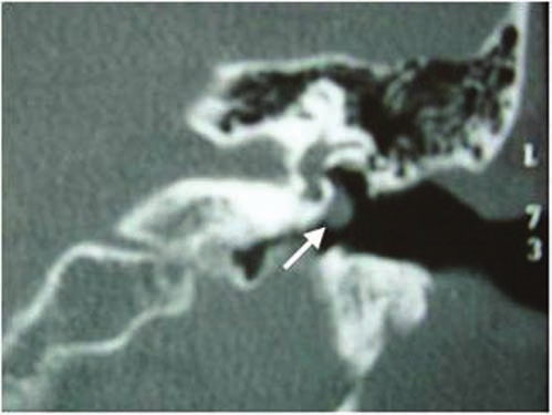 Figura 2. Tomografia computadorizada de ossos temporais do lado esquerdo, corte coronal, demonstrando imagem com densidade de partes moles, sobre o promontório e abaixo da janela oval (seta).