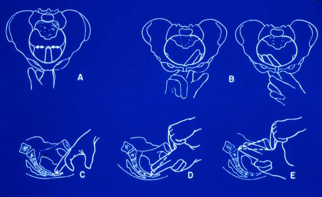 Pelvimetria Relação útero-fetal Feto Peso a