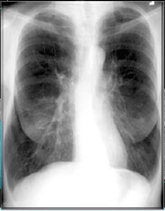 Risco Cardiovascular na DPOC Fatores associados FATORES MECÂNICOS Hiperinsuflação Pulmonar Redução enchimento diastólico Redução do enchimento coronariano FATORES INFLAMATÓRIOS E OXIDATIVOS Rigidez