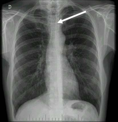 O conhecimento das linhas mediastinais é importante na avaliação da radiografia simples de tórax: Linha de junção anterior: ponto de encontro entre os pulmões anteriormente (figura 23).