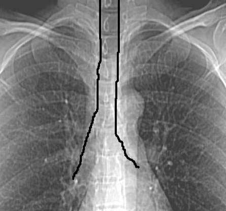 Linha da aorta descendente (figura 27): deve estar à esquerda da coluna vertebral. A porção ascendente da aorta é de difícil visualização, a não ser que haja uma ectasia ou um aneurisma da aorta.