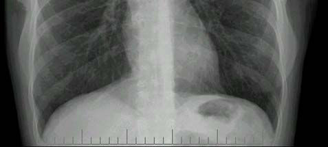 Figura 2. Segmentos do esterno na radiografia simples de tórax em perfil.