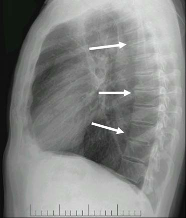 Figura 4. Demonstração das costelas posteriores e anteriores. Figura 5. Coluna vertebral assinalada na radiografia em perfil.
