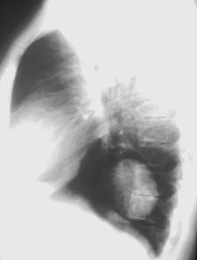 Figura 15. Pneumonia da língula, borrando os contornos cardíacos esquerdos, pois a língula e o coração são anteriores e têm densidade igual. Figura 16.