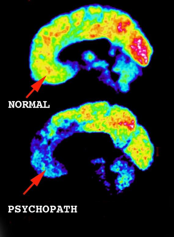 A recente ênfase verificada nos trabalhos de Blair, quanto ao papel do córtex ventromedial, estrutura contígua ao córtex orbitofrontal situada na extremidade inferior do