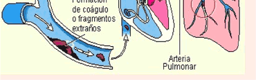 Embolia Pulmonar: Fatores de Risco; Sintomas: Associação dispnéia, taquipnéia e dor pleurítica