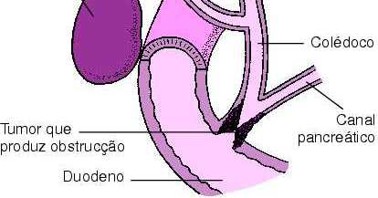 EXAME ABDOMINAL Colecistite Febre, dor e leucocitose; Irradiação da Dor; Fatores de