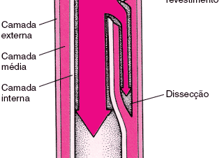 DOR TORÁCICA Dissecação Aórtica: 60-80 anos: HAS; Colagenoses; Alargamento Aórtico;
