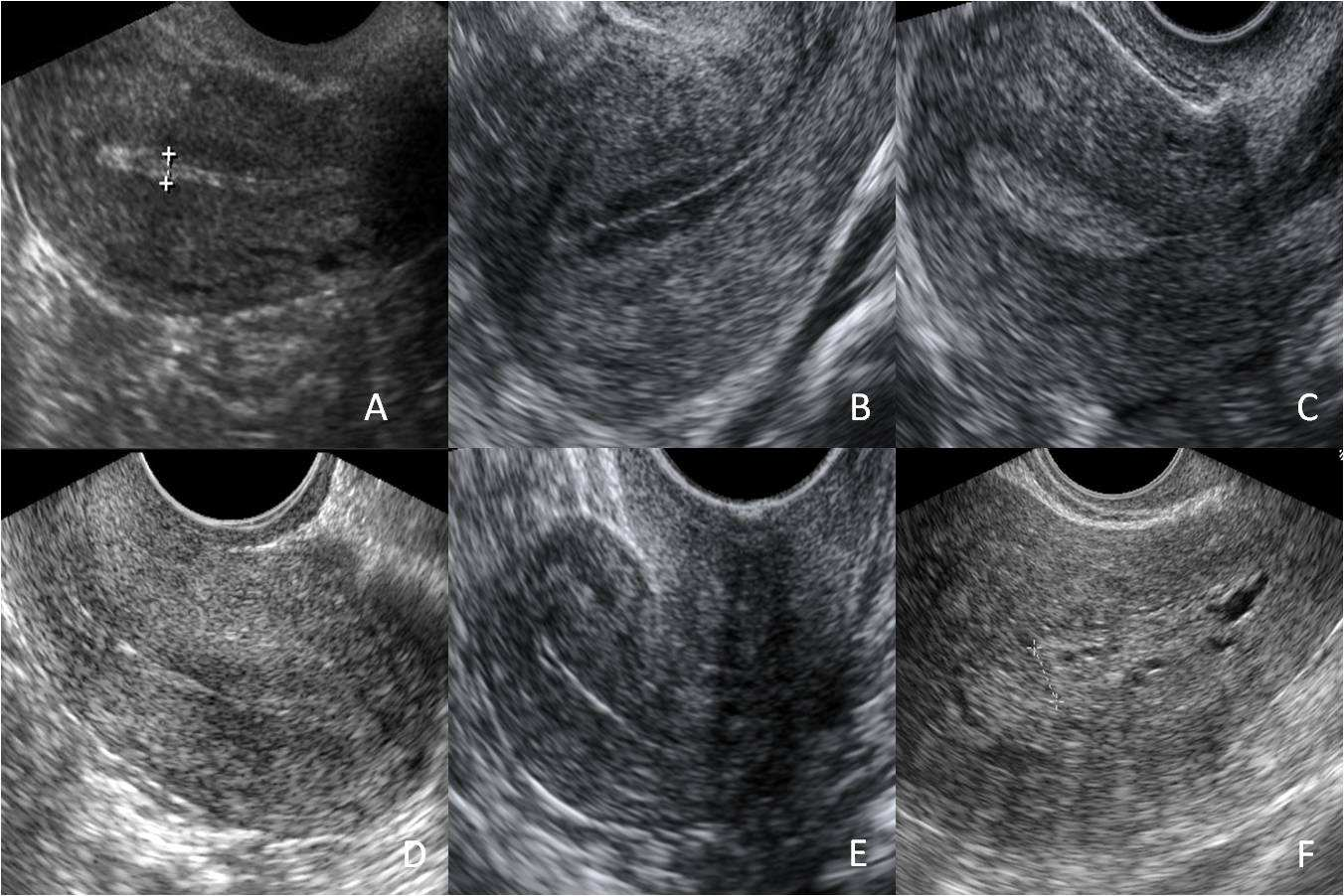 Fig. 4 - Abordagem supra-púbica A: útero e ovário direito em corte transversal; B: útero em corte longitudinal. Fig.