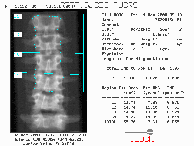 142 Figura 38 - Relatório do teste de densitometria óssea do segmento B 1, fornecido pelo equipamento Hologic g) após a obtenção dos resultados dos parâmetros calculados pelo programa OsteoImage, as
