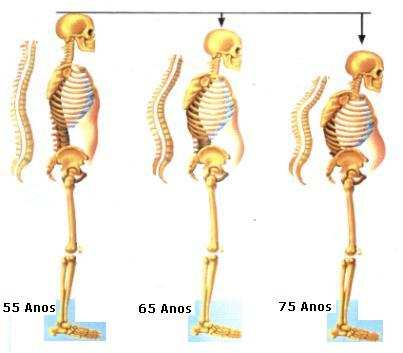 39 hérnia de hiato e incontinência urinária. Esses efeitos viscerais das fraturas vertebrais causam maior perda da qualidade de vida, ao longo dos anos, do que os de fraturas de ossos longos.