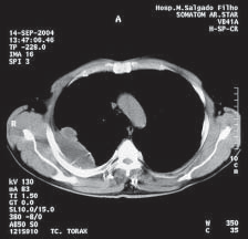Figura 5 Radiografia de tórax feita 14 dias antes da internação evidenciando vários estilhaços do projétil de arma de fogo, além da destruição do arco costal adjacente.