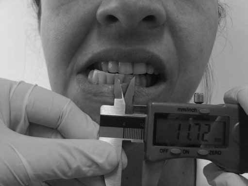 depressão do lábio inferior com o movimento de mostrar os dentes inferiores.