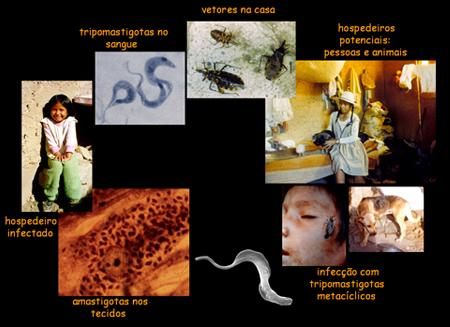 CHAGAS :