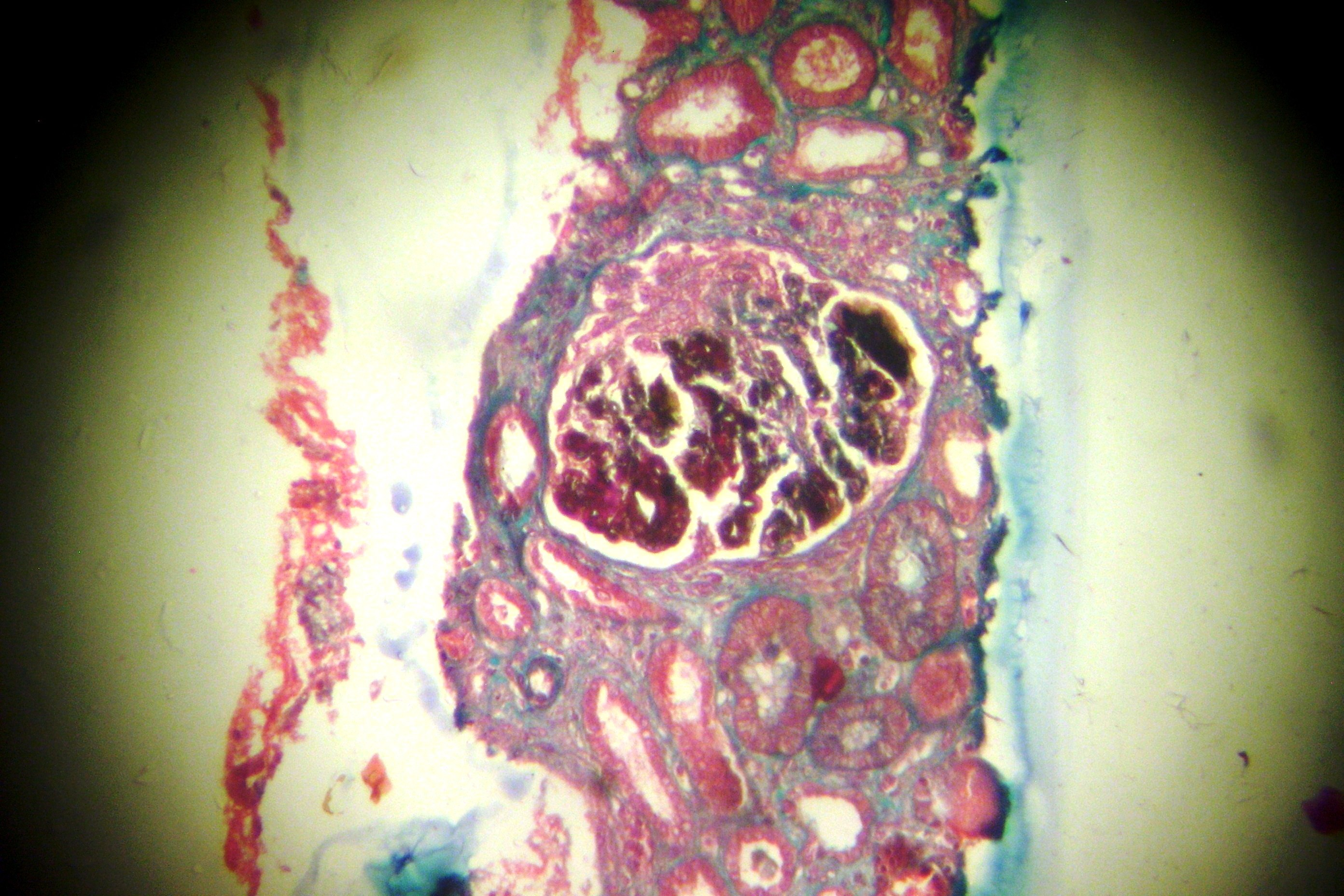 Células mesangiais com discreta proliferação global e difusa sem expansão. Apenas 1 glomérulo mostra rotura da membrana basal com formação de crescente epitelial em forma de semi-lua.