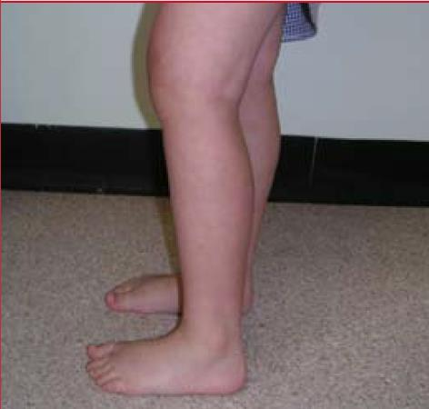Figura Manobras de screening (as marcadas em negrito são diferentes das do adulto) Com o joelho a 90 o rode a perna para fora (rotação interna do quadril) e para dentro (rotação externa do quadril) O