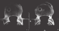 LESÕES DA COLUNA VERTEBRAL NOS ESPORTES Fig. 1 Ressonância magnética de voleibolista de 18 anos com lombalgia. Imagem pesada em T2, corte sagital mediano.