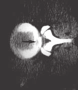 Fig. 4 Tomografia axial computadorizada, nível do disco L4-L5 de surfista com 20 anos. Fratura do anel apofisário (seta) que acompanha hérnia discal central L4-L5. Fig.