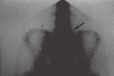 Fig. 7 Tomografia axial computadorizada de futebolista com 17 anos e lombalgia. Corte paralelo ao istmo de L5, mostrando espondilólise bilateral. Fig.
