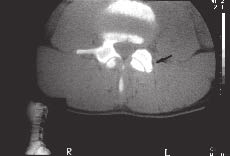 LESÕES DA COLUNA VERTEBRAL NOS ESPORTES Fig. 13 Tomografia axial computadorizada do paciente da figura 12.