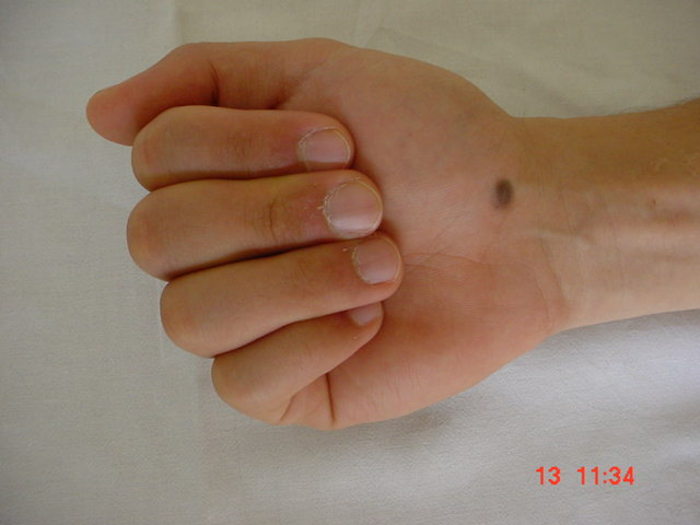 Avaliação Fisioterapêutica do Punho e da Mão 4. Inspeção Exame das faces palmar e dorsal da mão.