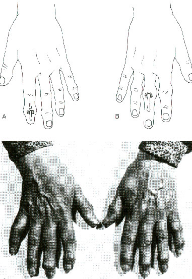4.1 Deformidades Comuns das Mãos e dos Nódulos de Heberden: observados na superfície dorsal das articulações interfalângicas distais e estão associados com a