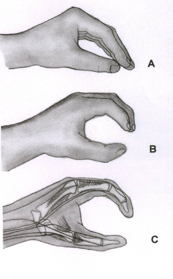 4.2 Posição de Função da Mão A posição funcional do punho é a de extensão entre 20 e 35 com desvio ulnar de 10 a 15