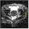 O exame evidenciou formação expansiva retroperitoneal volumosa, aspecto heterogêneo e lobulado. A difusão evidenciou restrição, com medida do CDA de 0,80 x 10 ˉ ³ s/mm².