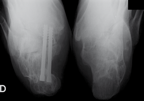 Fractura do calcâneo Figura 4. Rx axial do calcâneo onde se visualiza a translação.