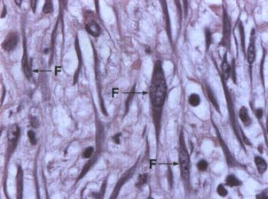 FIBROBLASTOS Fig. 5.2 Corte histológico de tecido conjuntivo frouxo mostrando vários fibroblastos (F) ativos com núcleo grande, nucléolo evidente e citoplasma abundante e basófilo (ver também Fig. 5.4).