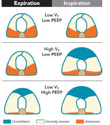 H ong CM, Xu DZ, Lu Q, Cheng Y, Pisarenko V, Doucet D, Brown M, Aisner S, Zhang C, Deitch EA, Delphin E: Low tidal volume and high positive end-expiratory pressure mechanical