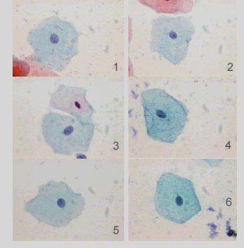 70 métodos foi relativamente alta. Estes resultados indicam que, nas amostras em formaldeído, a identificação celular não foi a mesma que na citologia convencional, para estes dois tipos celulares.