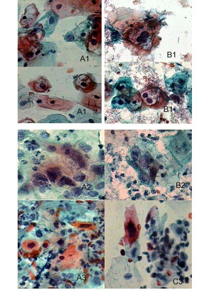 80 FIGURA 7 FOTOMICROGRAFIAS DE CITOLOGIA CÉRVICO-VAGINAL DE CASOS CLASSIFICADOS COMO ANORMALIDADES EPITELIAIS SEGUNDO SISTEMA BETHESDA 2001 Citologia convencional (A); citologia em meio líquido com