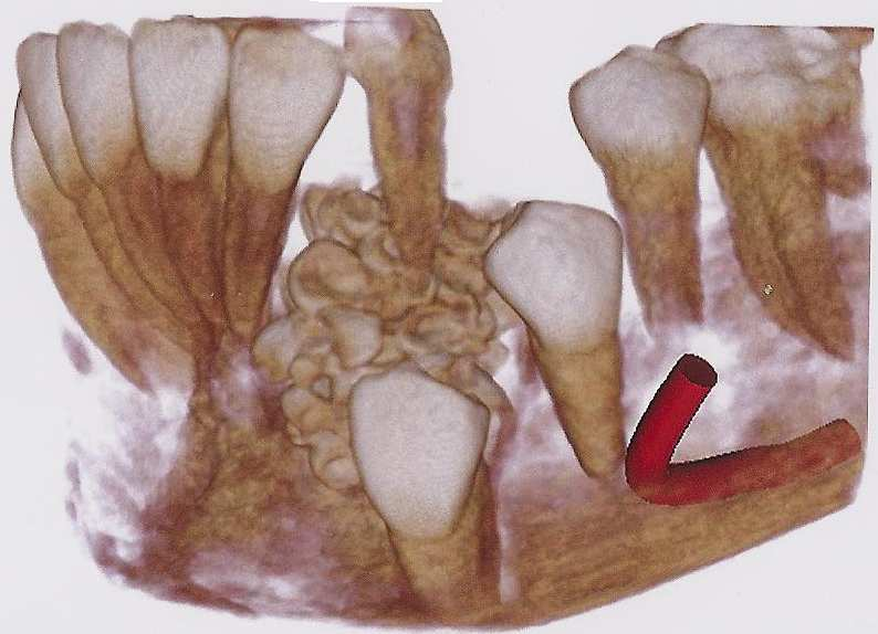 e pré-molares inferiores, que se apresentou constituído por 97 dentículos.