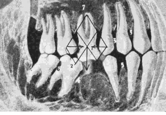 Formação de bolsas periodontais nos dentes adjacentes ao espaço da perda dentária, pela inclinação que estes dentes adquirem. Retenção de alimentos e cáries. Extrusão do antagonista.